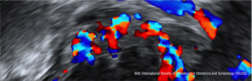 Ultraschallbild mit farbiger Doppler-Darstellung von Blutfluss in Rot und Blau